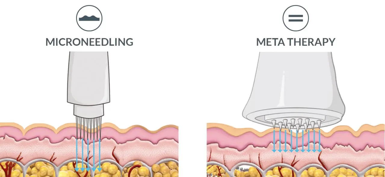 microneedling vs meta therapy
