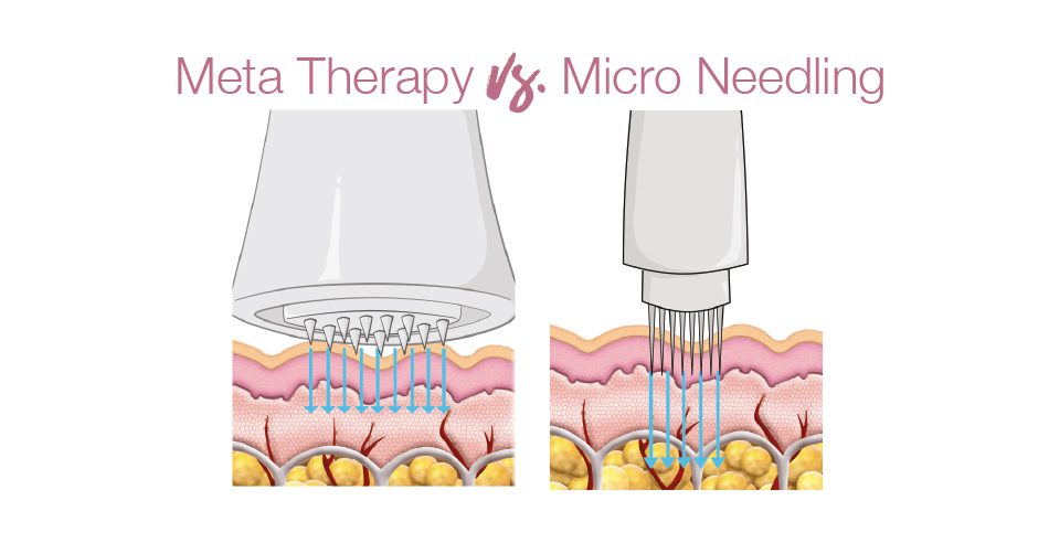 Meta therapy vs microneedling